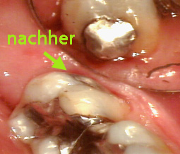 Polierte alte Füllung