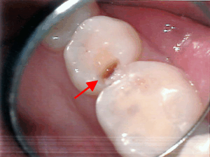Fäulnis unter neuer Füllung