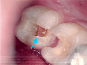 Foto vom Zahn 37 mit Karies