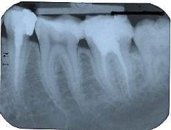 röntgen nach 2 Wurzelbehandlungen