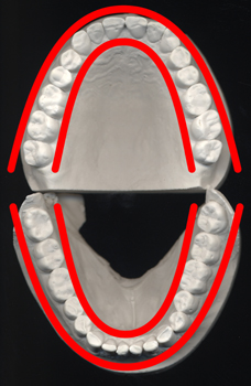 Doppel U auf Gipsmodell